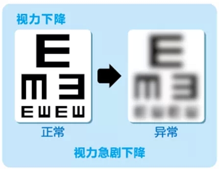 視網(wǎng)膜脫離啥癥狀？這張圖告訴你！