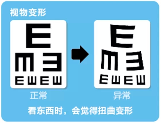 視網(wǎng)膜脫離啥癥狀？這張圖告訴你！