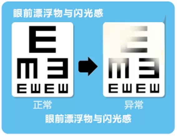 視網(wǎng)膜脫離啥癥狀？這張圖告訴你！