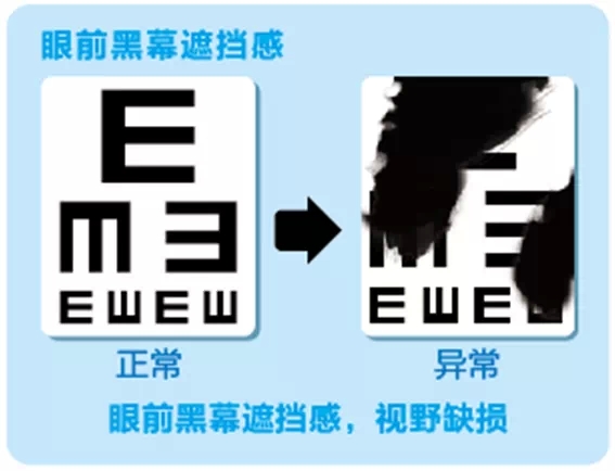 視網(wǎng)膜脫離啥癥狀？這張圖告訴你！