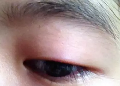 “美目貼”別依賴，小心眼皮下垂