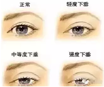 “美目貼”別依賴，小心眼皮下垂