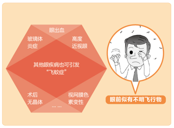 【看圖學知識】眼前有黑影該怎么辦