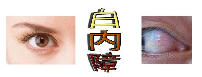 白內(nèi)障手術患者應注意哪些事項