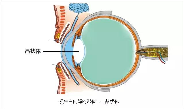 眼科主任告誡白內(nèi)障這幾大誤區(qū)，80%的老人上當(dāng)