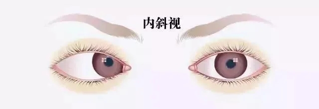 關于斜視，這幾個誤區(qū)害人不淺!