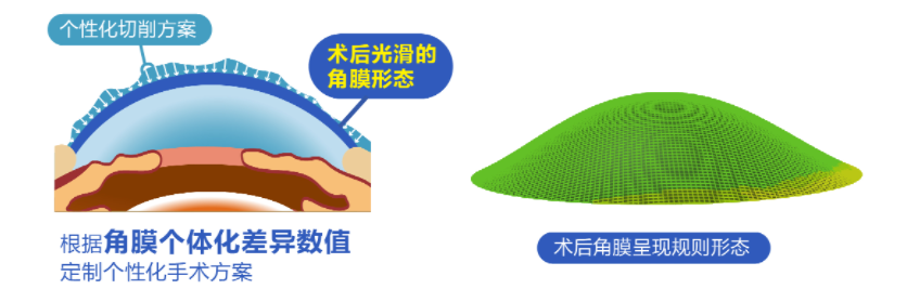 微雕優(yōu)視飛秒，重新定義角膜屈光手術(shù)，讓視力多看一行！